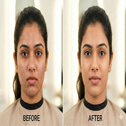 Acna treatment (Pimples)